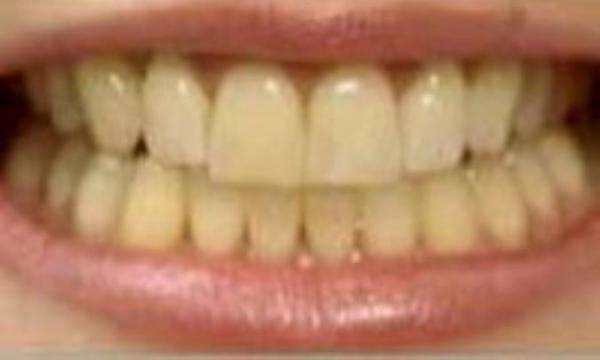 5 راهکار برای فرار از دندان های زرد