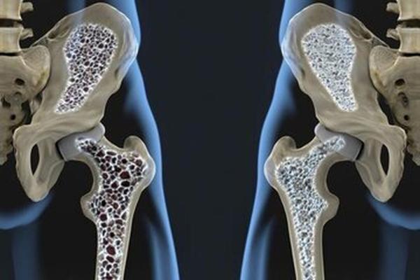 6 هشدار پوکی استخوان در مردان؛ این علائم را جدی بگیرید